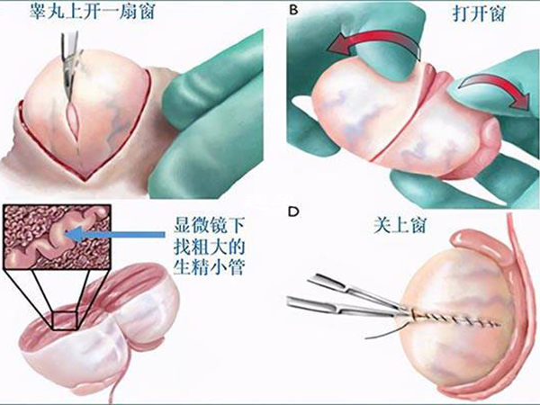 顯微取精手術流程