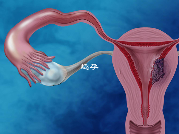 AMH值高於7可能存在多囊