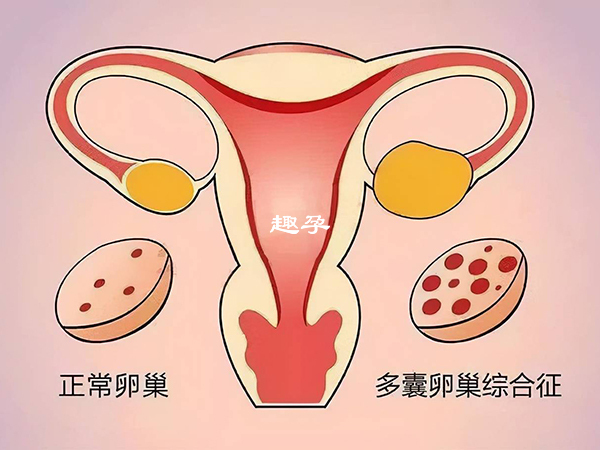 多囊卵巢不孕的主要原因