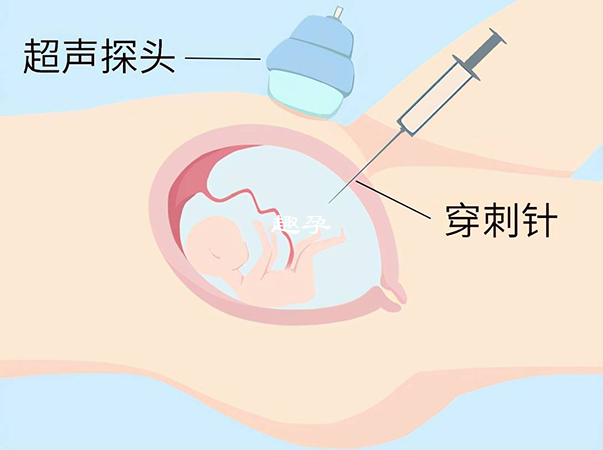 無創DNA檢查高風險需要完善羊水穿刺