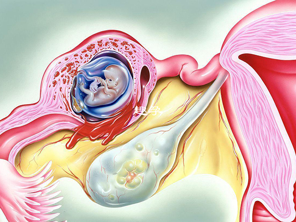 习惯性流产容易导致宫外孕发生