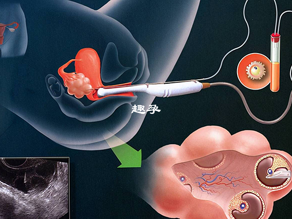 胚胎移植是双角子宫试管过程中最后一个步骤