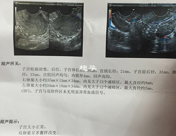 LH和FSH比值大于2可能是多囊