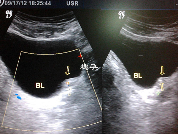 胎兒腎積水是因為輸尿管堵塞