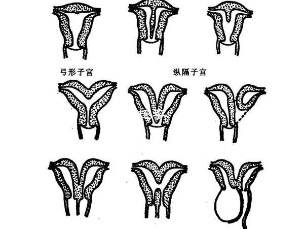 殘角子宮也是先天性的發育畸形