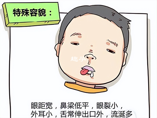 唐氏综合征婴儿的眼距较宽