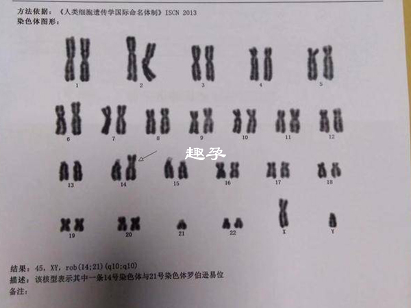 罗伯逊易位发病率只有不到0.1%