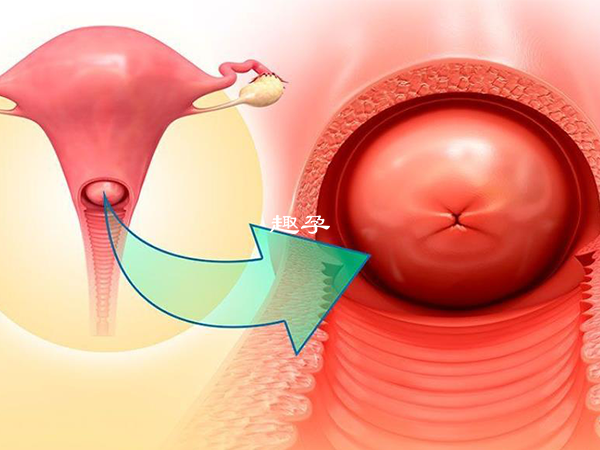 宫颈肥大严重者会出现宫颈表面糜烂