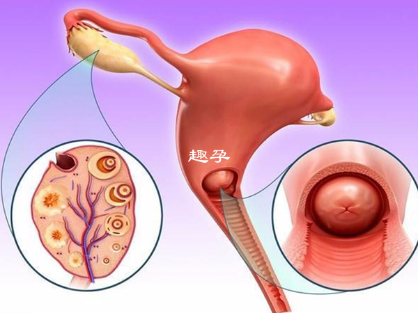 tct檢查能有效預防宮頸癌