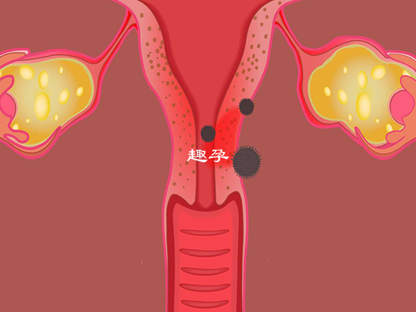 宮頸炎是一種常見婦科疾病