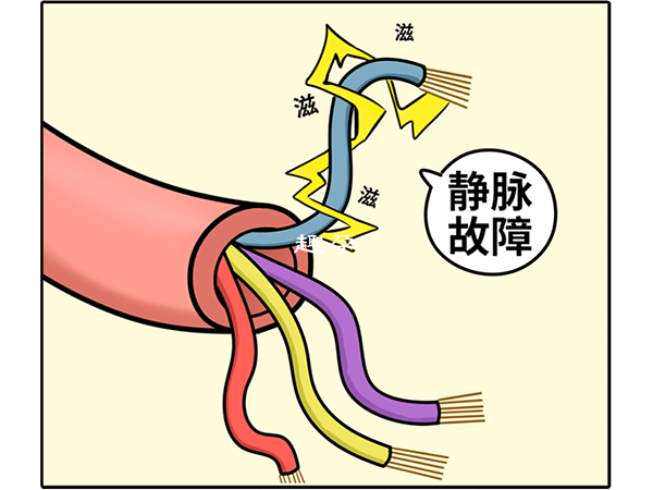 嚴重的精索靜脈曲張需要手術治療