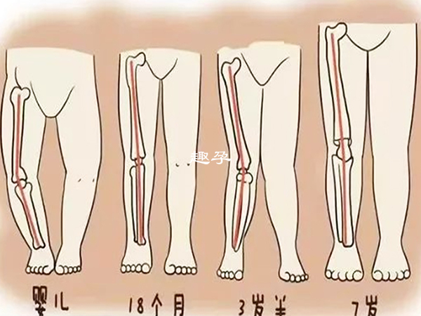 罗圈腿需要从小预防