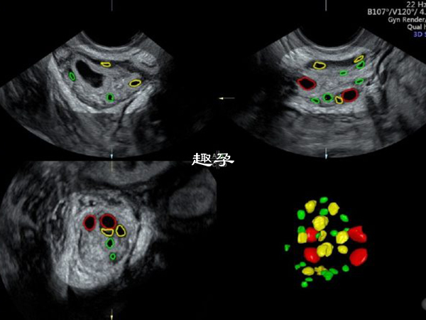 正常竇卵泡個數在5-10個之間