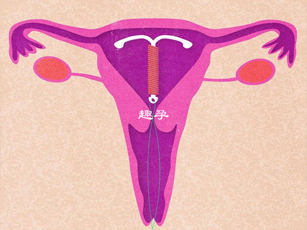 節育環是通過阻礙胚胎著床達到避孕效果