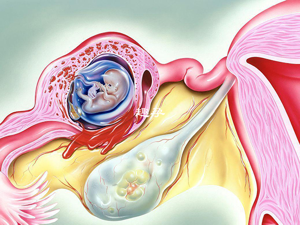 着床出血可能是先兆流产和宫外孕