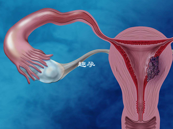 宫腔粘连患者也有怀孕希望