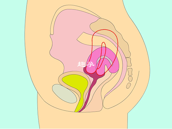 子宮後位女性懷孕比較艱難