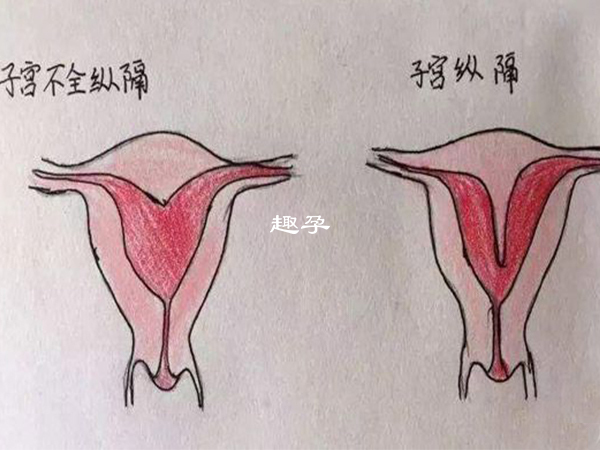 纵膈子宫应先进行切除治疗再做试管助孕