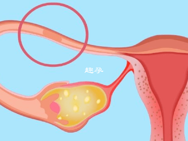 输卵管狭窄是可以怀孕的