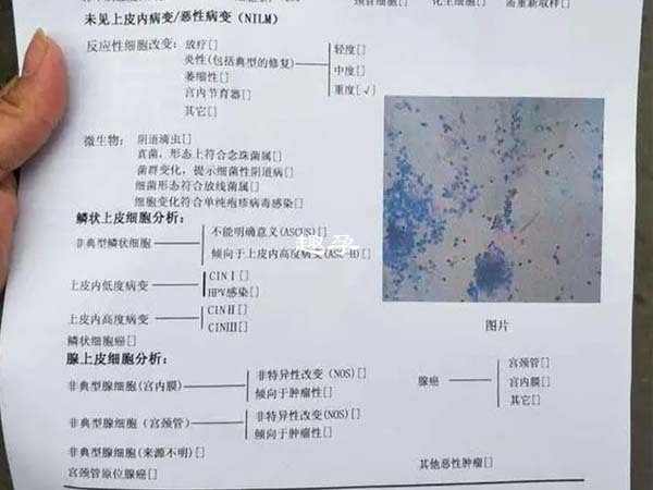 tct检查报告结果示例