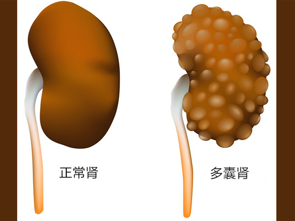 多囊肾的特征是肾脏上形成许许多多囊泡