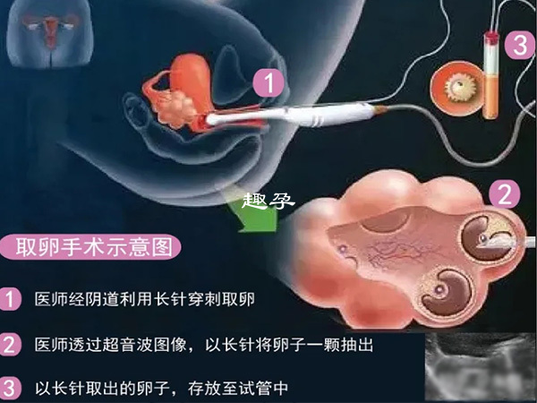 取卵手術示意圖