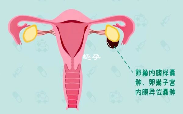 巧克力囊腫患者懷孕會很困難