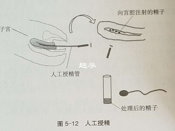 人工授精中已经包含hiv洗精的步骤