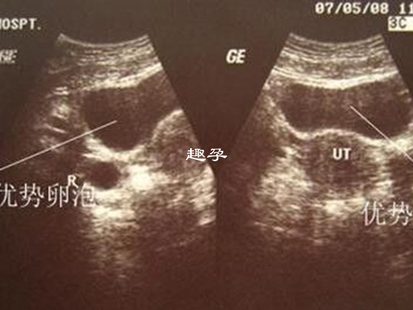 卵泡发育到18mm的时候称之为是优势卵泡