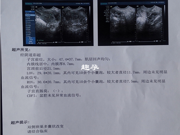 多囊卵巢(PCO)≠多囊卵巢综合征(PCOS)