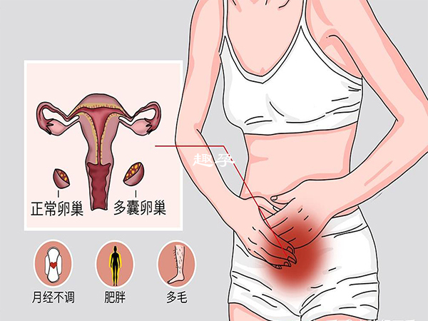 多囊卵巢綜合症