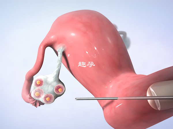 打三针尿促激素卵泡一天涨1.5mm左右