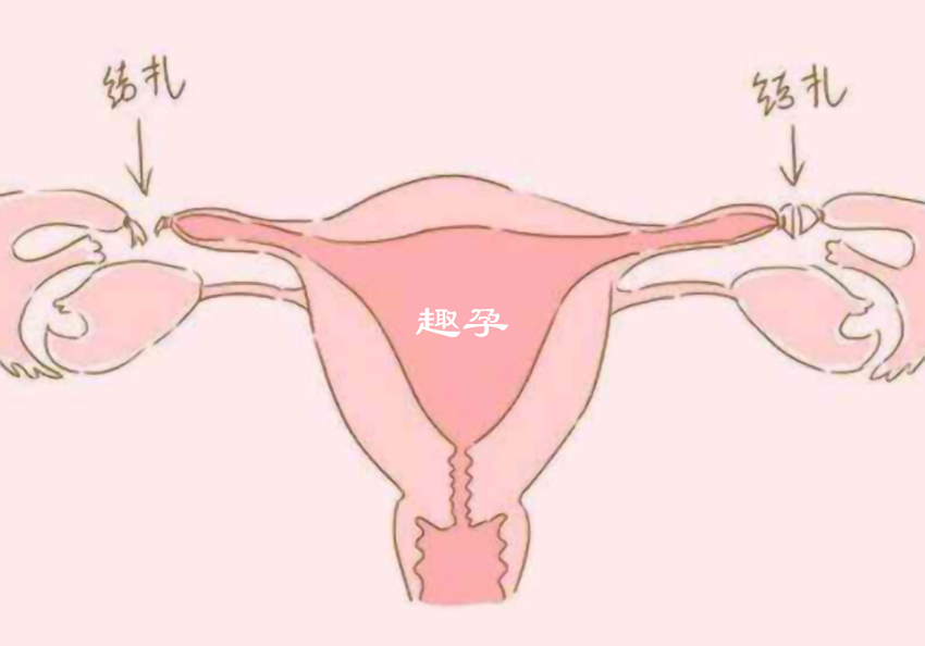 女性結紮