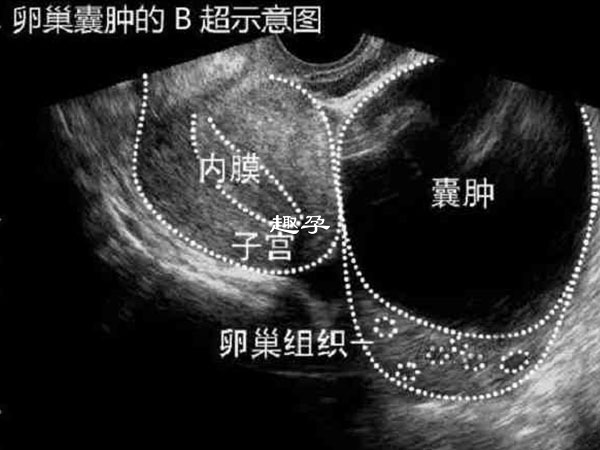 卵巢囊腫B超示意圖