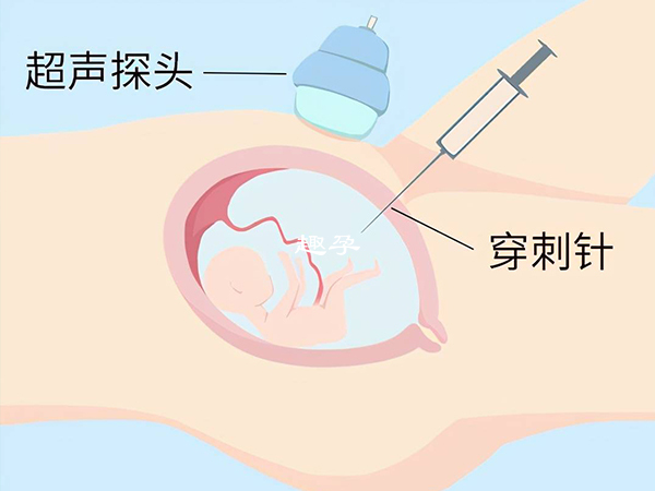 羊水膜穿刺可以鉴别胎儿性别