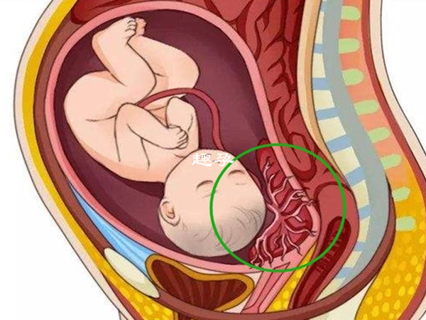 胎盘前置会选择剖腹产