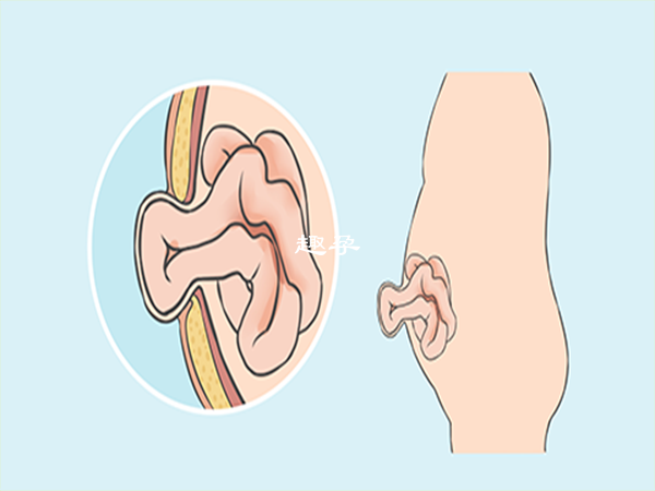脐疝需要及时治疗