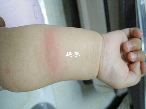 麻疹疫苗接種後出現紅腫屬正常現象