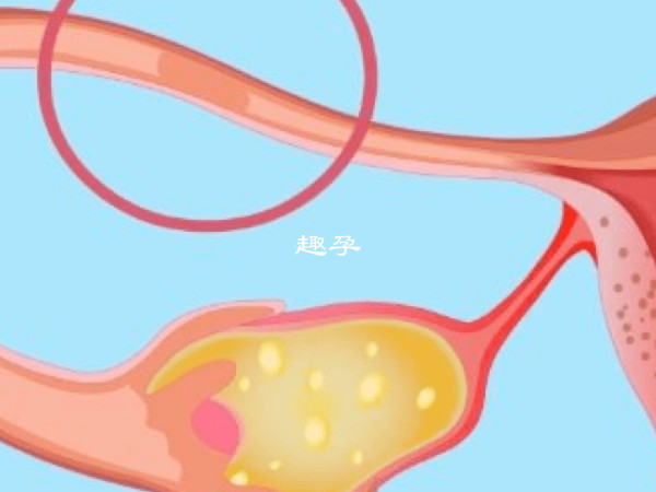 輸卵管切除手術後禁止同房一個月