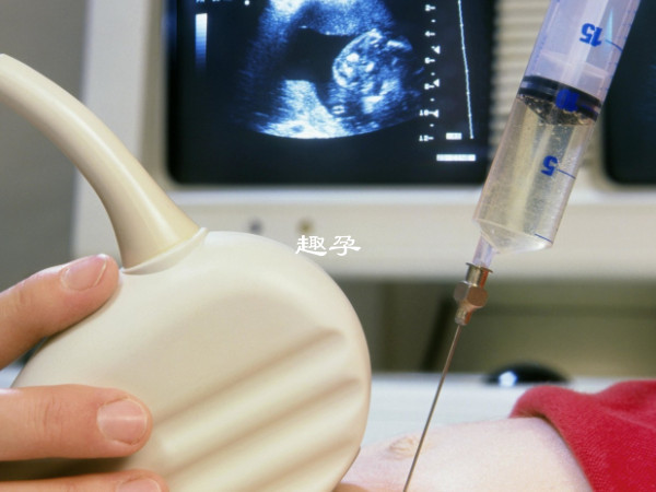 羊水穿刺檢查準確率較高