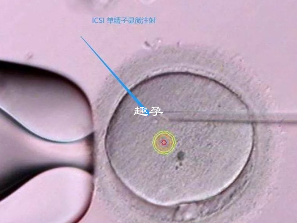 人工受精和试管婴儿会有区别