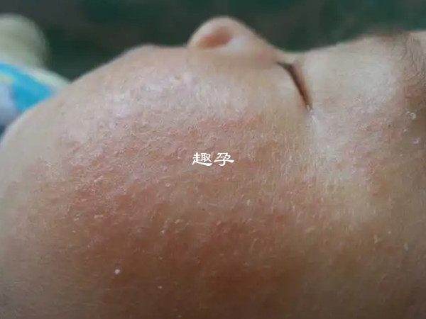 溼疹患處面板粗糙