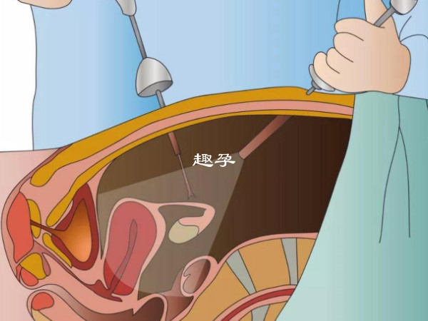 試管胚胎移植步驟