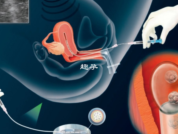 取卵针会最先刺穿阴道壁