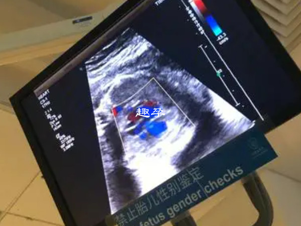 孕28周前每4周检查一次