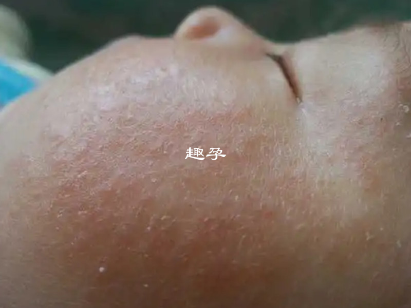 嬰兒溼疹和熱空氣有一定的關係