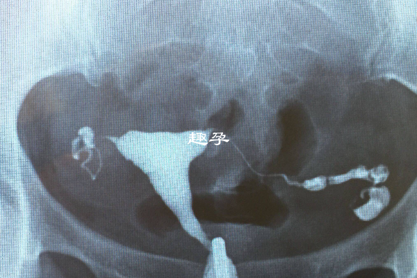 造成黃體破裂的原因解析