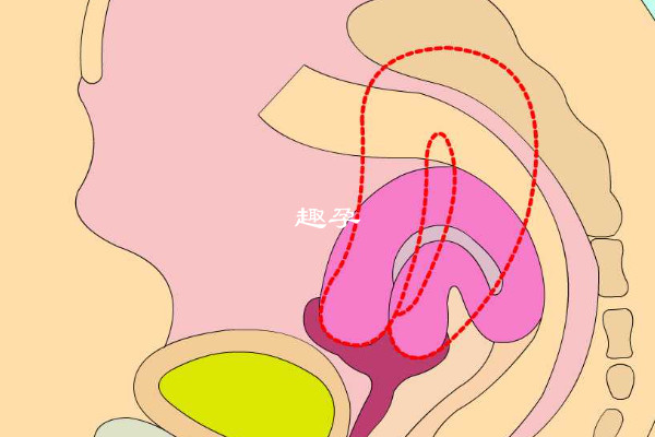 详解残角子宫能不能怀孕