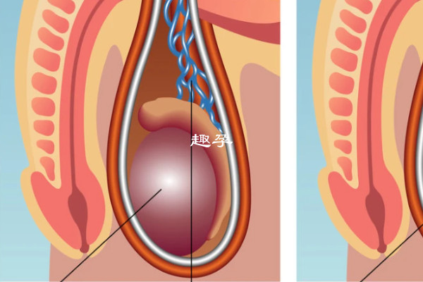 詳解什麼是精索靜脈曲張