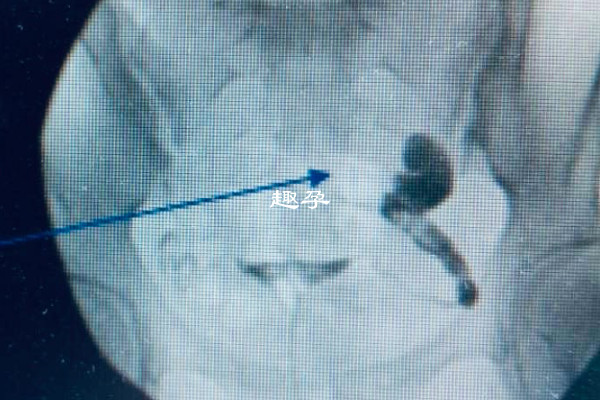 輸卵管積水的原因是什麼解析